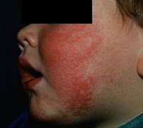 Image result for Fifth Disease
