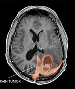 Image result for Meningioma Radiology