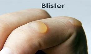 Image result for blister