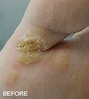 Image result for Foot Wart Removal