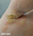 Image result for Fast Wart Removal