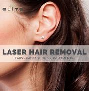 Image result for Laser Ear Hair Removal
