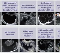 Image result for Stage 1 Ovarian Cancer Ultrasound