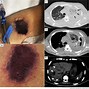 Image result for Necrotic Skin Lesions