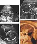 Image result for Anterior Encephalocele Ultrasound Holoprosencephaly