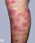 Image result for Baby Eczema
