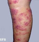 Image result for Eczema in Your Hair
