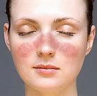 Image result for Allergic Rash On Face