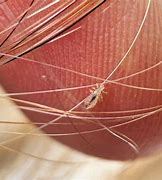 Image result for Lice On Humans