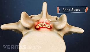 Image result for Bone Spurs Near the Foramen