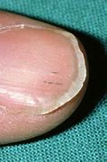 Image result for Little Black Lines On Fingernails