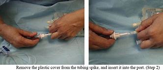 Image result for Hypodermoclysis