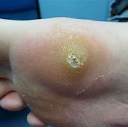 Image result for Best Treatment for Warts On Face