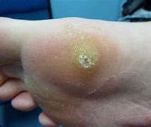 Image result for Warts Covering Bottom of Foot