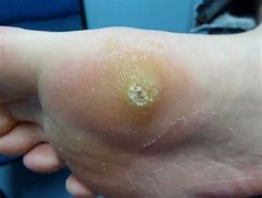 Image result for Pics of Plantar Warts