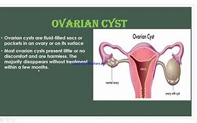 Image result for Paratubal Cyst Size Chart