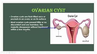 Image result for Paratubal Cyst Cartoon