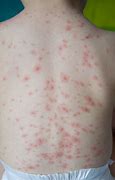 Image result for Mild Case of Chickenpox