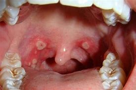 Image result for Sore Throat Look Like