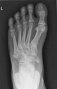 Image result for Avulsion Fracture of 5th Metatarsal Ligaments