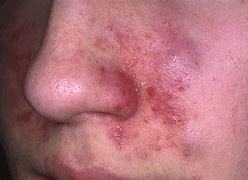 Image result for Eczema Molluscatum