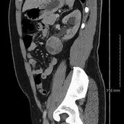 Image result for Left Lower Pole Kidney Mass