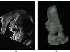 Image result for Fetal Face Views On Ultrasound