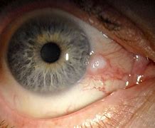 Image result for Conjunctival Papilloma Pterygium