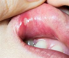 Image result for Ulcer On Lip