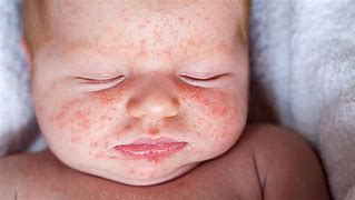 Image result for Childhood Rashes That Spread