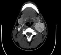 Image result for Carotid Tumor Neck