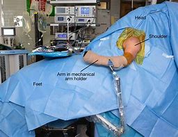 Image result for Shoulder Rotator Cuff Surgery Recovery