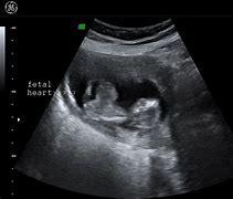 Image result for Ectopia Cordis Ultrasound