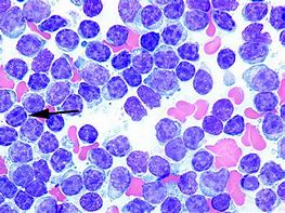 Image result for Chronic Lymphocytic Leukemia Cells