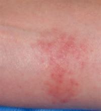 Image result for Nickel Allergic Reaction