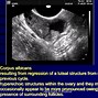 Image result for 9 Cm Cyst On Ovary