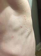 Image result for Molluscum Rash Stages