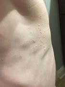 Image result for Molluscum Contagiosum Beetlejuice Blister