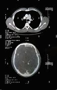 Image result for CT Image of Head and Neck in PC Screen