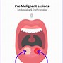 Image result for Papilloma of Tongue
