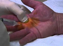 Image result for Percutaneous Trigger Finger Release
