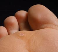 Image result for Wart Bottom of Foot