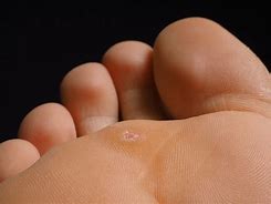 Image result for Plantar Wart On Side of Foot