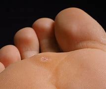 Image result for What Are Warts