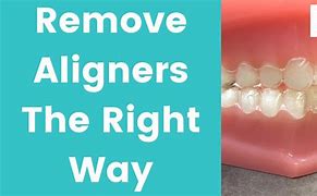 Image result for What Is at Home Clear Aligners