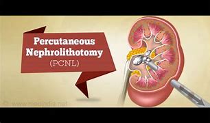 Image result for Kidney Stone Surgery Procedure