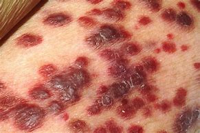 Image result for Kaposi Sarcoma Rash