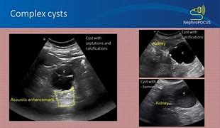 Image result for Complex Cyst with Mural Calcifictaions Ultrasound Kidney