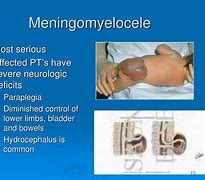 Image result for Meningomyelocele vs Meningocele