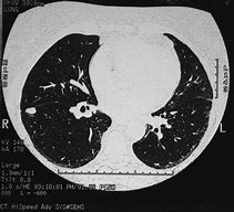 Image result for Solitary Pulmonary Nodule NCCN